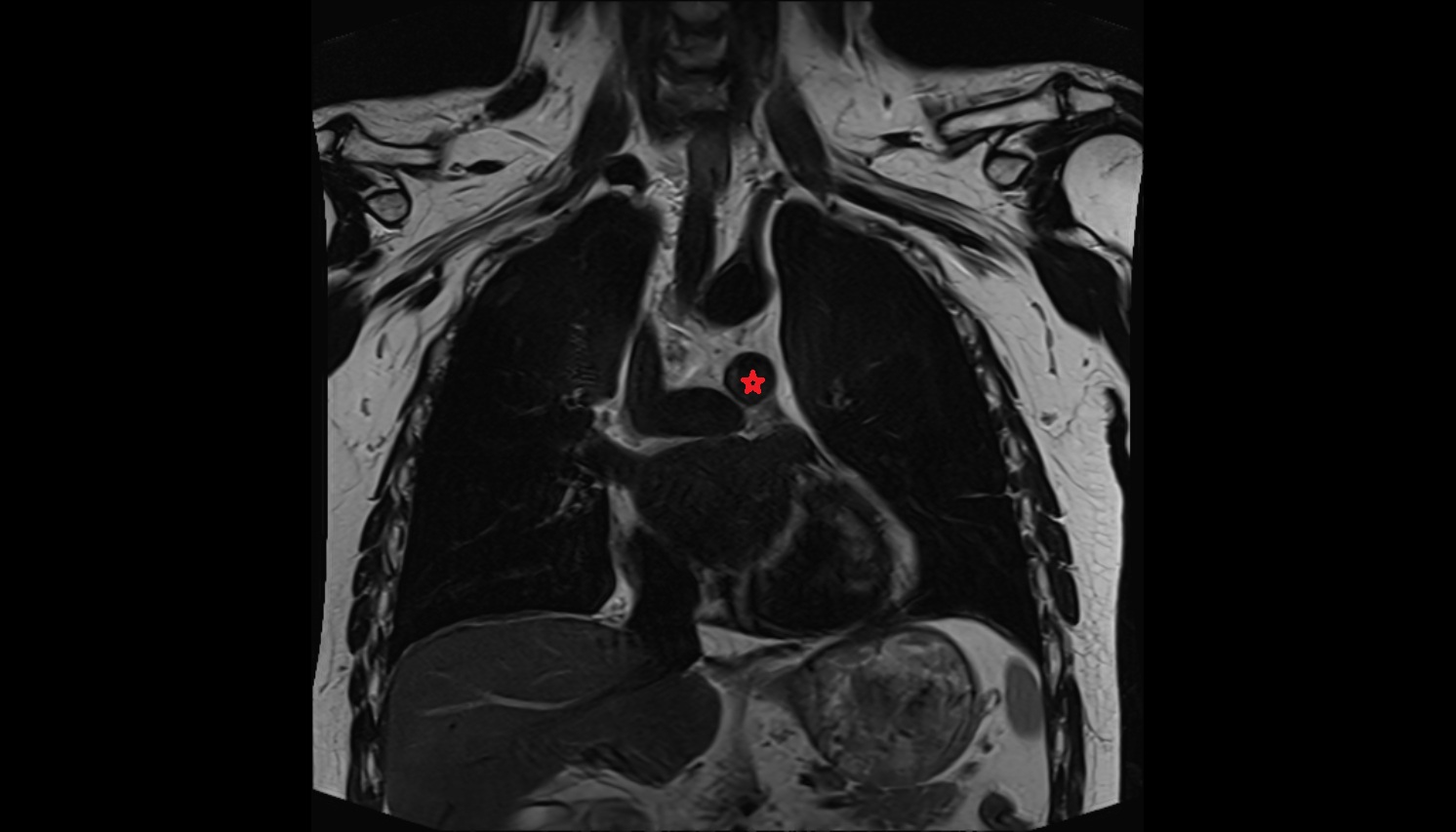 Left pulmonary artery  anatomy mri coronal  image -img-00000-00000
