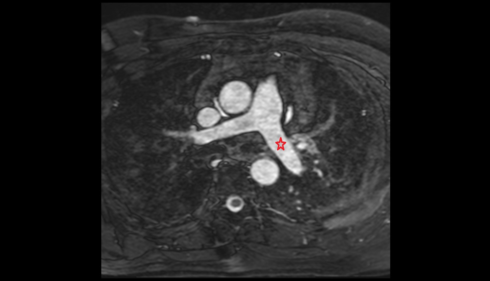 Left pulmonary artery mri image