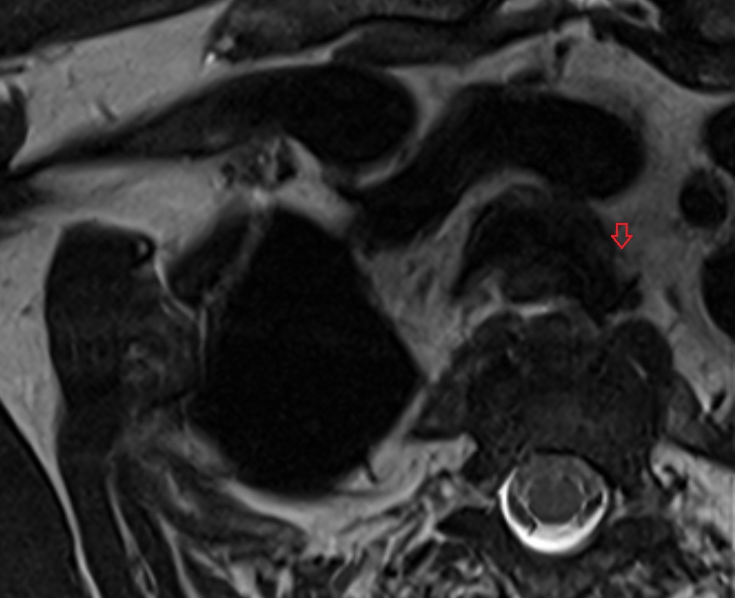 Left recurrent laryngeal nerve MRI axial  image -img-00000-00000