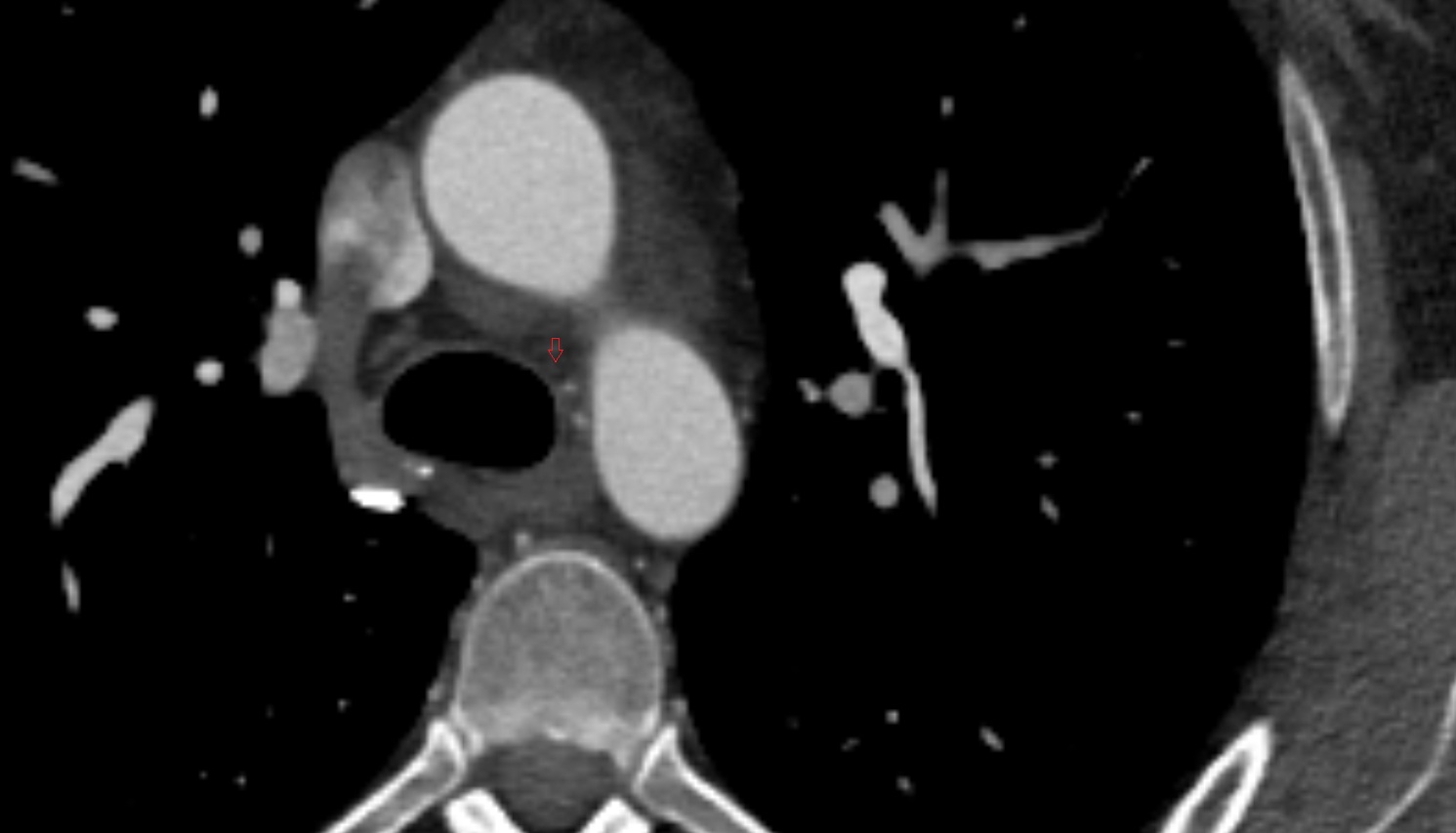 Left recurrent laryngeal nerve ct axial  image -img-00000-00000