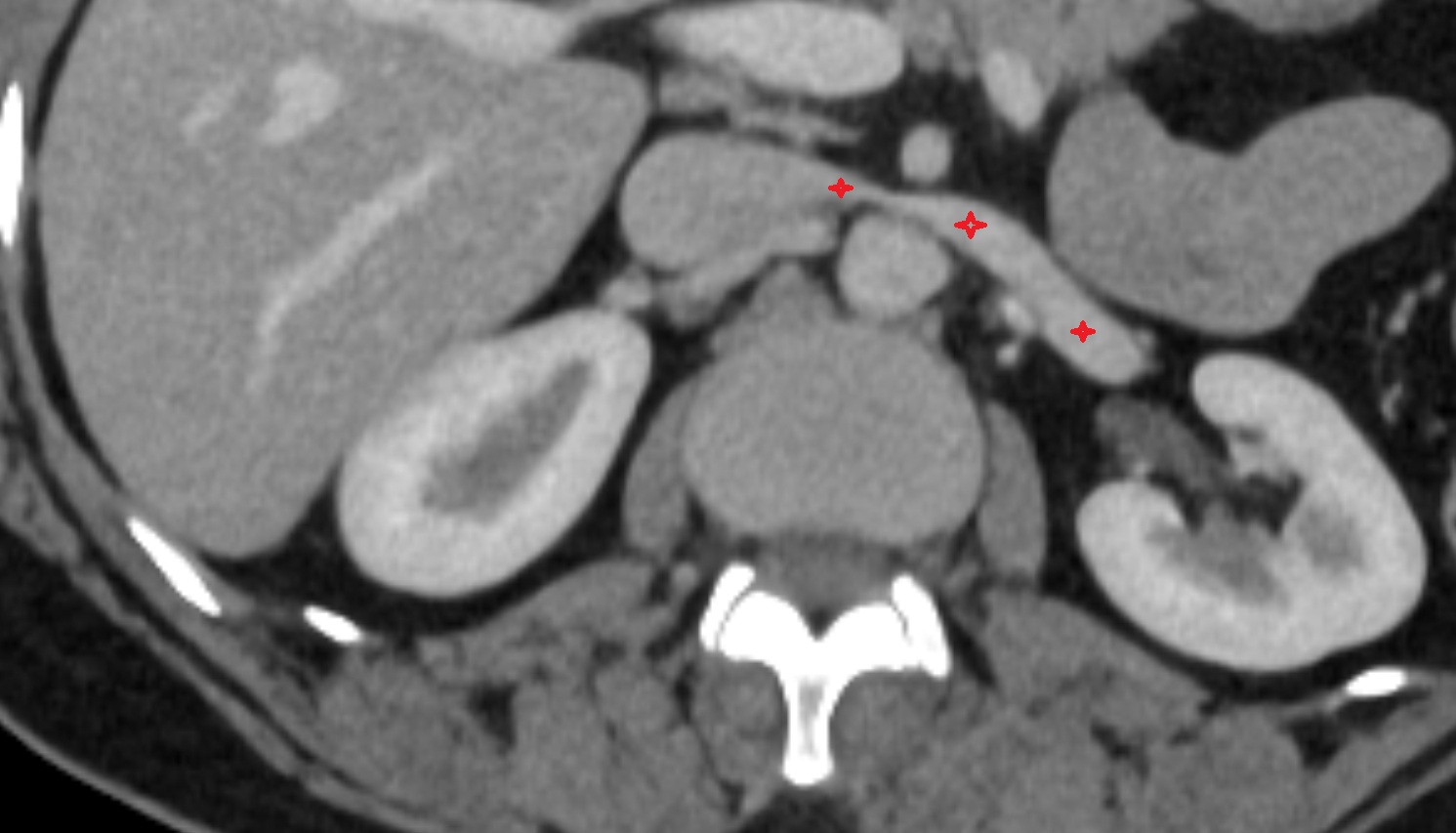 Left renal vein  CT AXIAL image anatomy  image -img-00000-00000