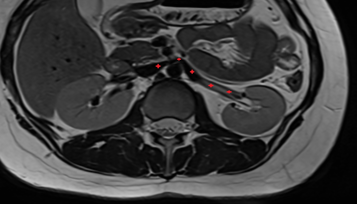 Left renal vein MRI AXIAL image anatomy  image -img-00000-00000