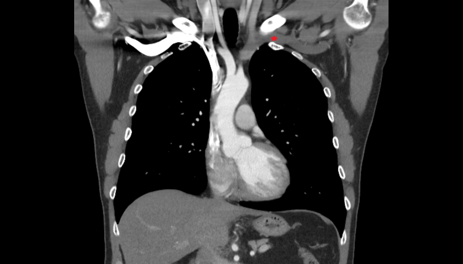 Left  subclavian vein anatomy CORONAL CT  image -img-00000-00000