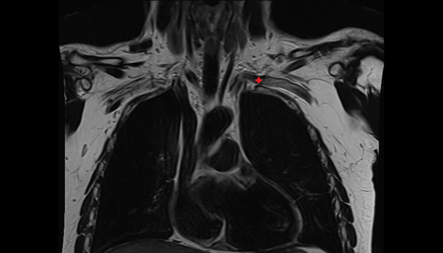 Left subclavian vein anatomy CORONAL MRI  image -img-00000-00000