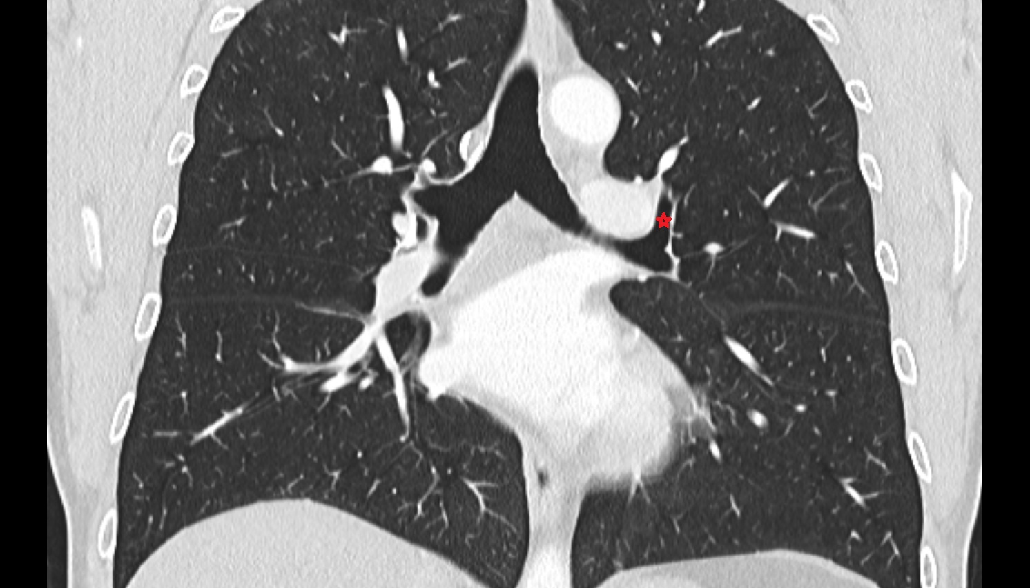 Left superior lobar bronchus  anatomy  CT coronal  image -img-00000-00000
