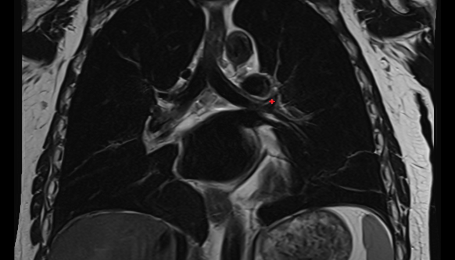 Left superior lobar bronchus  anatomy MRI coronal  image -img-00000-00000