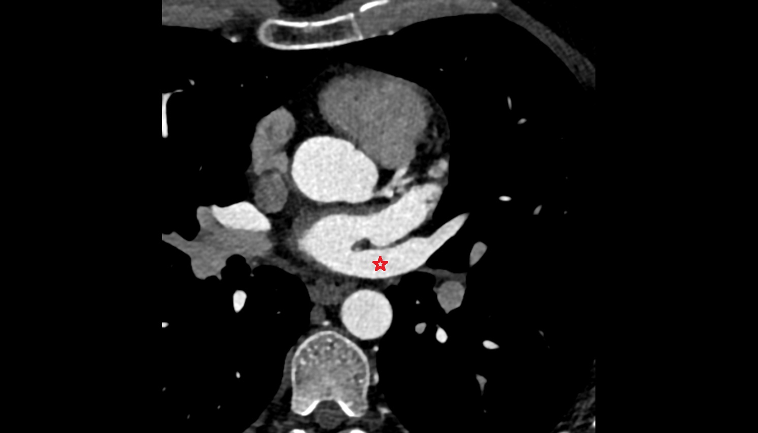 Left superior pulmonary vein anatomy CT axial  image -img-00000-00000