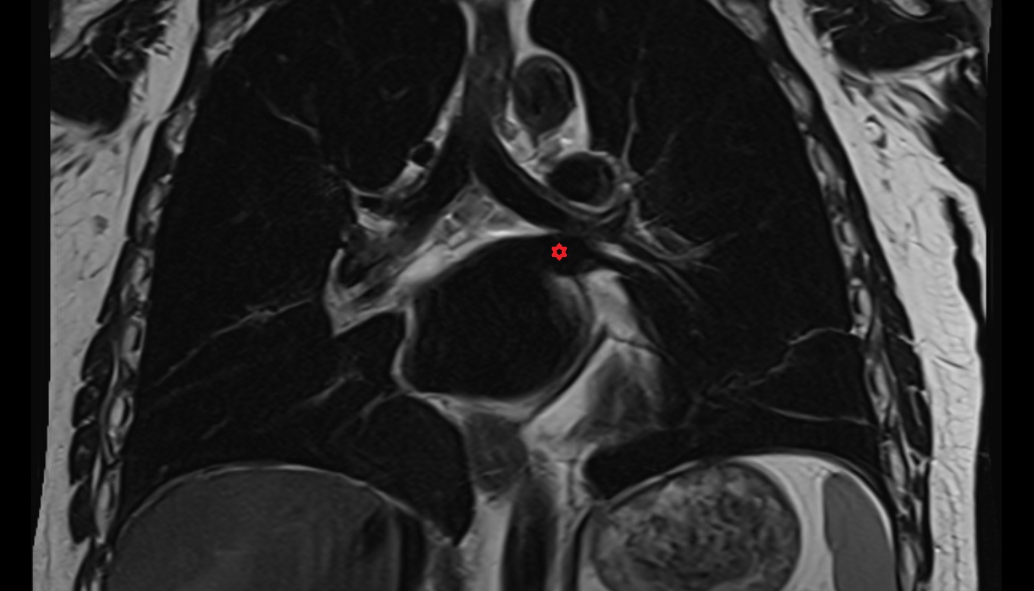 Left superior pulmonary vein  anatomy MRI coronal  image -img-00000-00000
