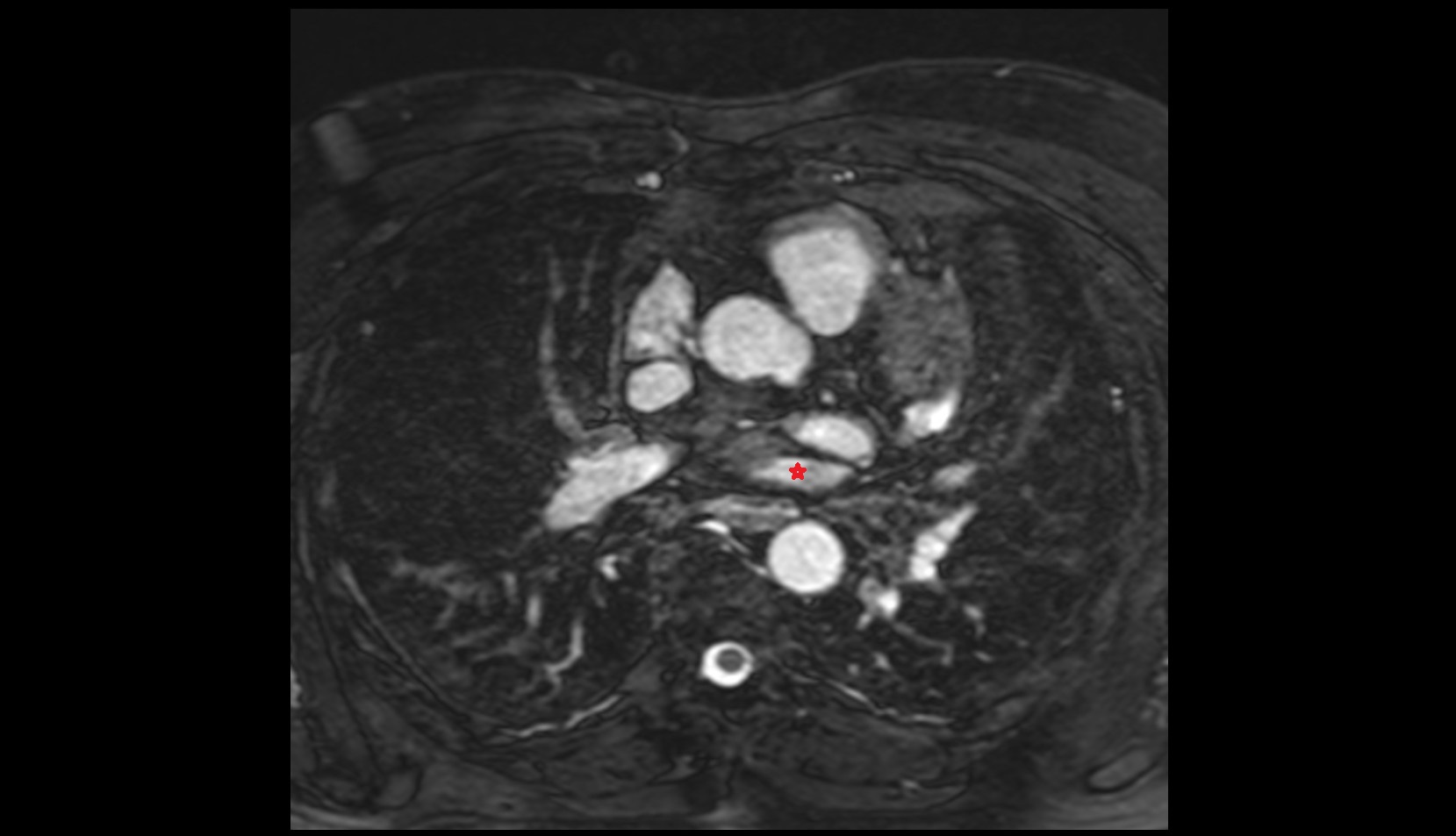 Left superior pulmonary vein mri image