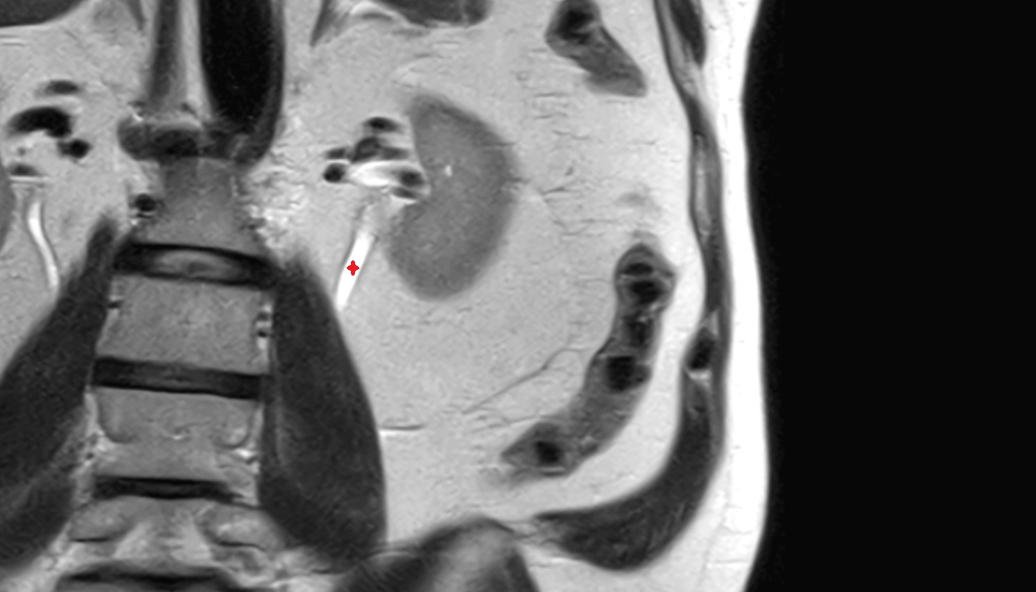 Left ureter  MRI coronal image anatomy  image -img-00000-00000