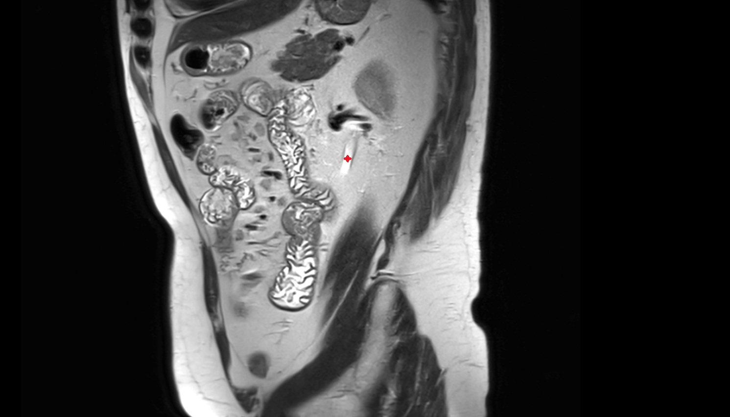 Left ureter  MRI sagittal  image anatomy  image -img-00000-00000
