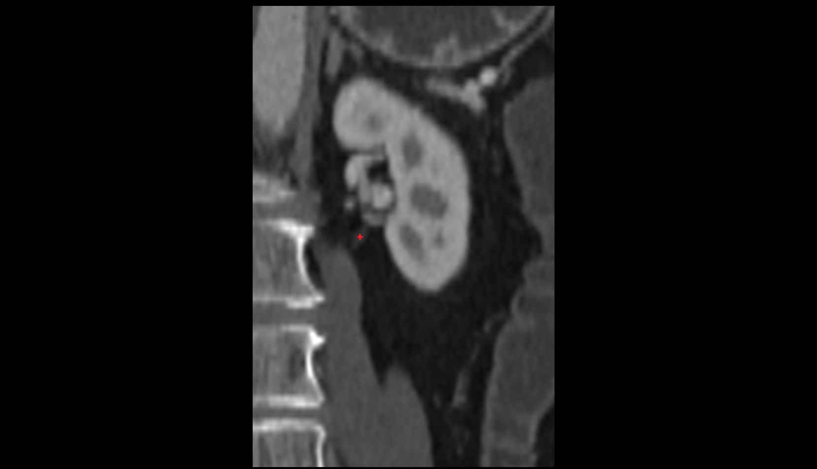 Left ureter coronal image