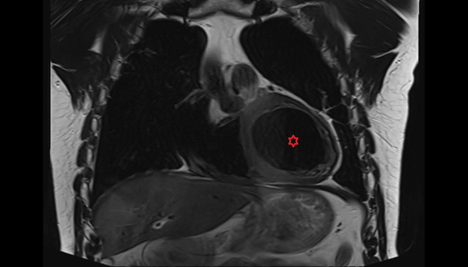 Left ventricle anatomy  MRI coronal image -img-00000-00000