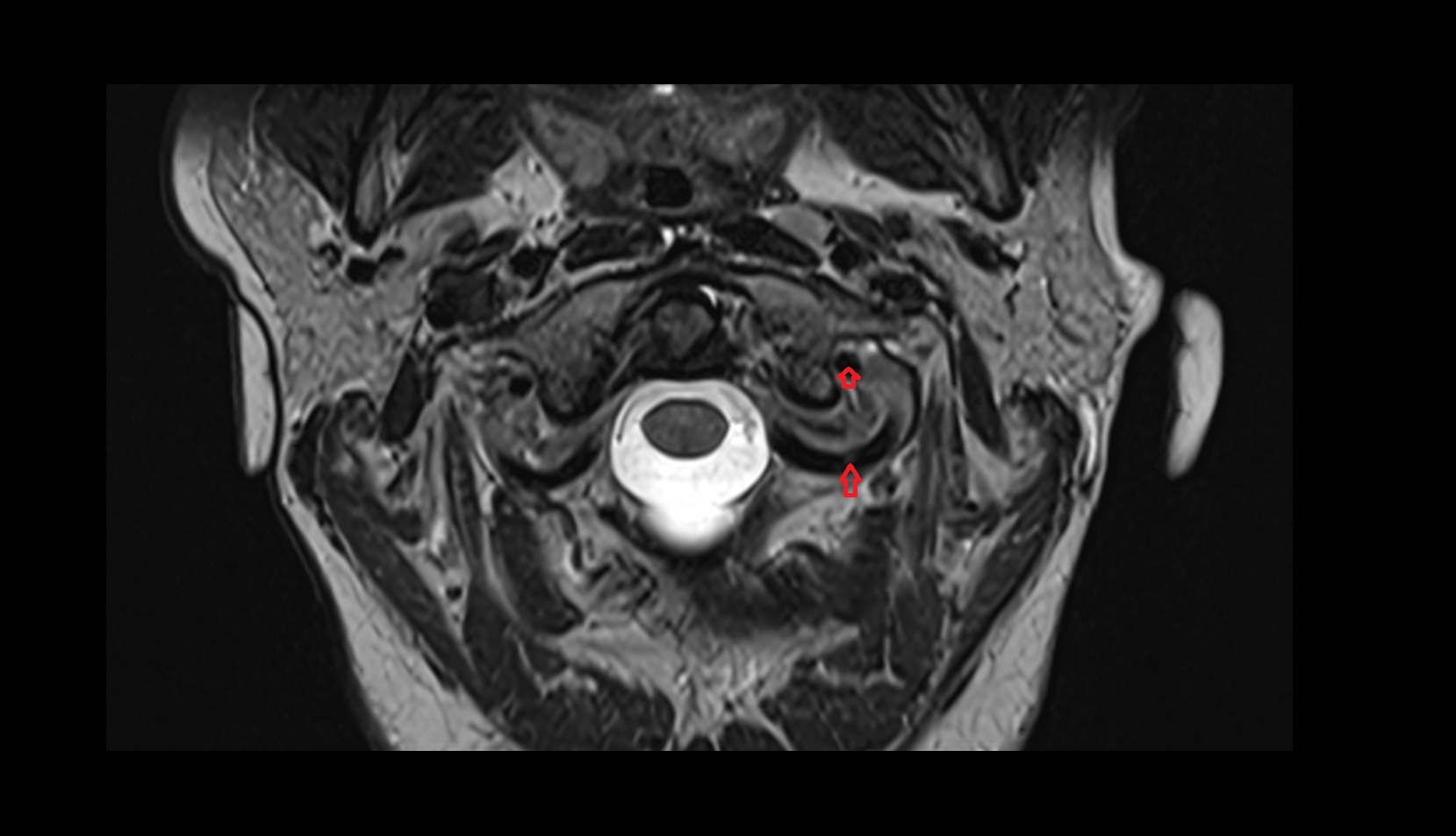 Left vertebral artery (atlantic part) mri axial image