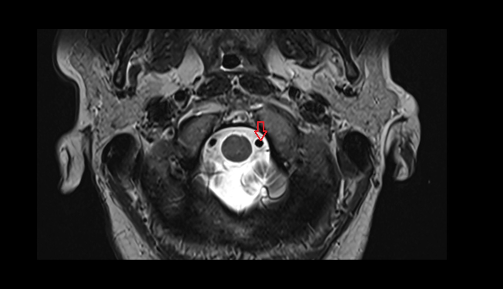 Left vertebral artery (intracranial part)
