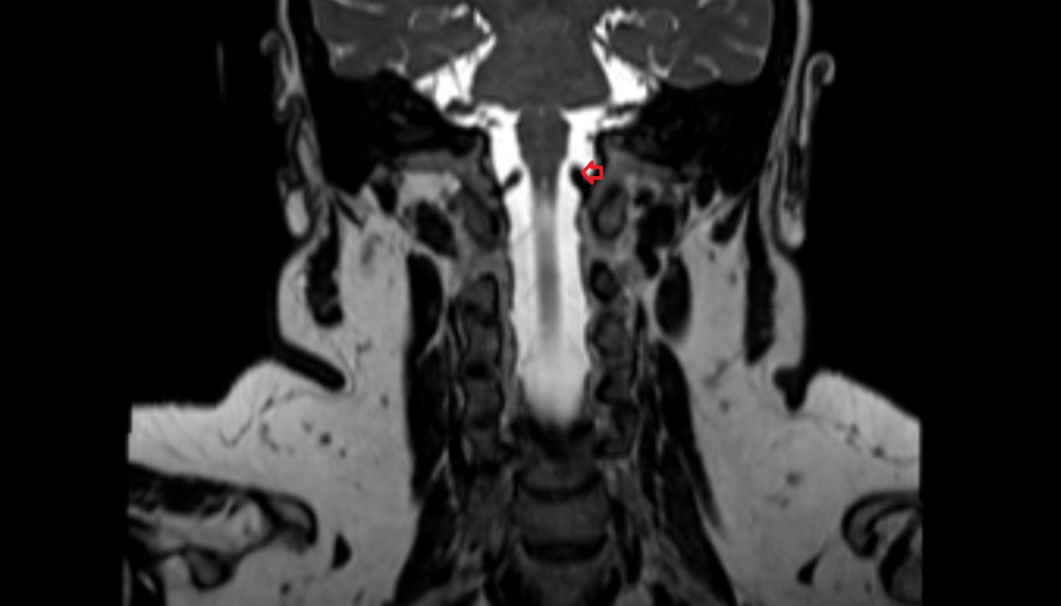 Left vertebral artery (intracranial part)  mri coronal image -img-00000-00000
