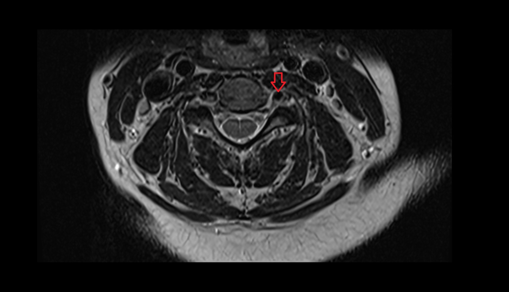 Left vertebral artery mri axial image