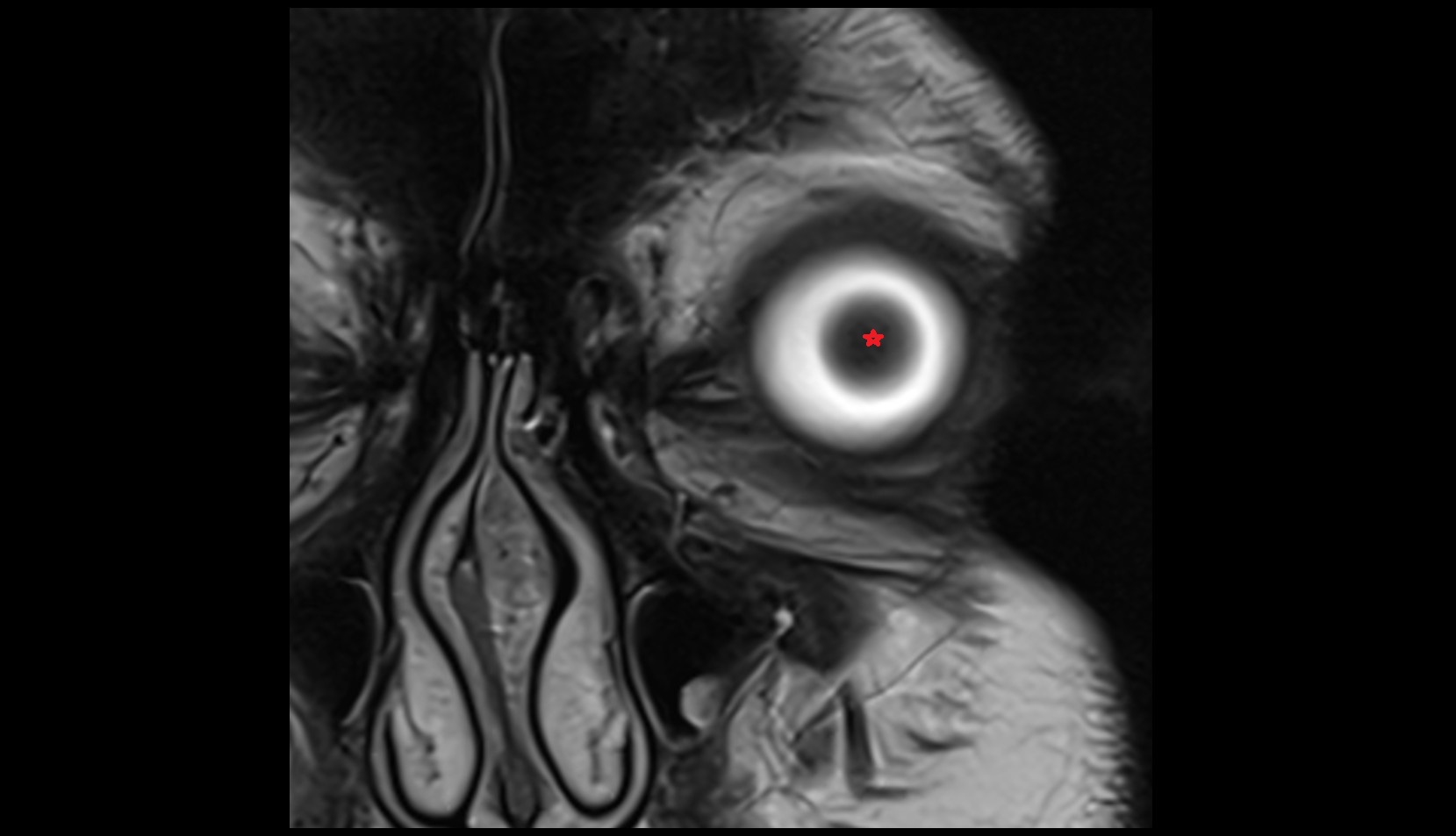 Lens mri image