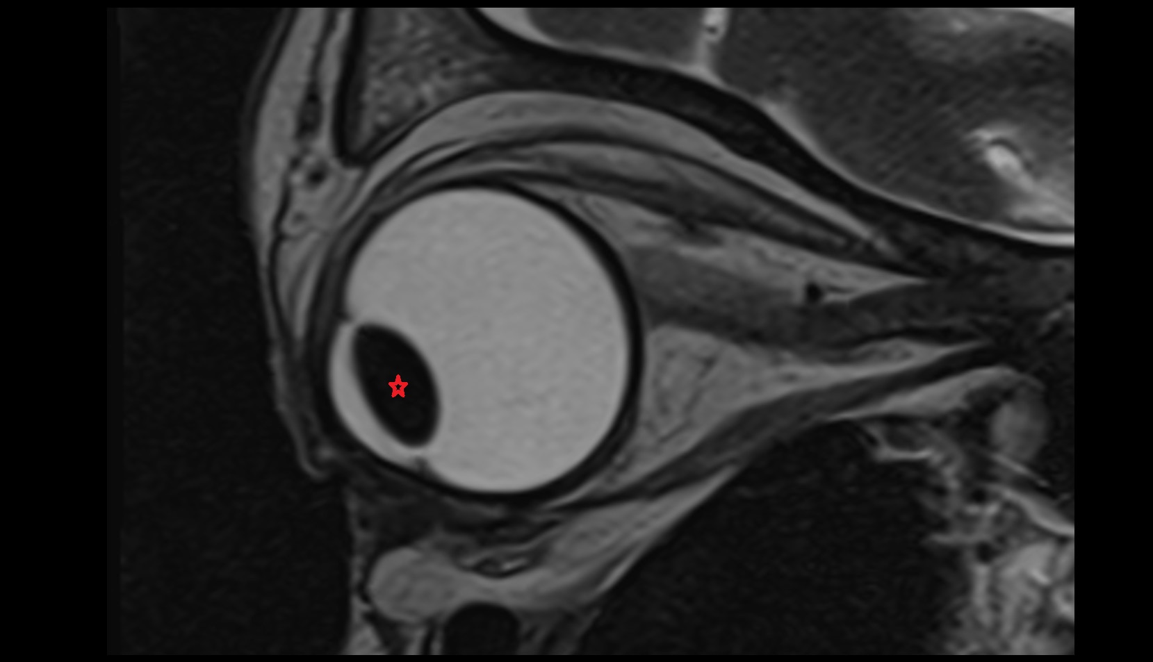 Lens mri image t2 sagittal