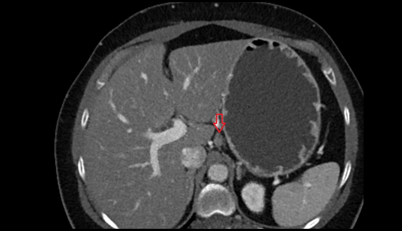 Lesser curvature lymph nodes axial ct image