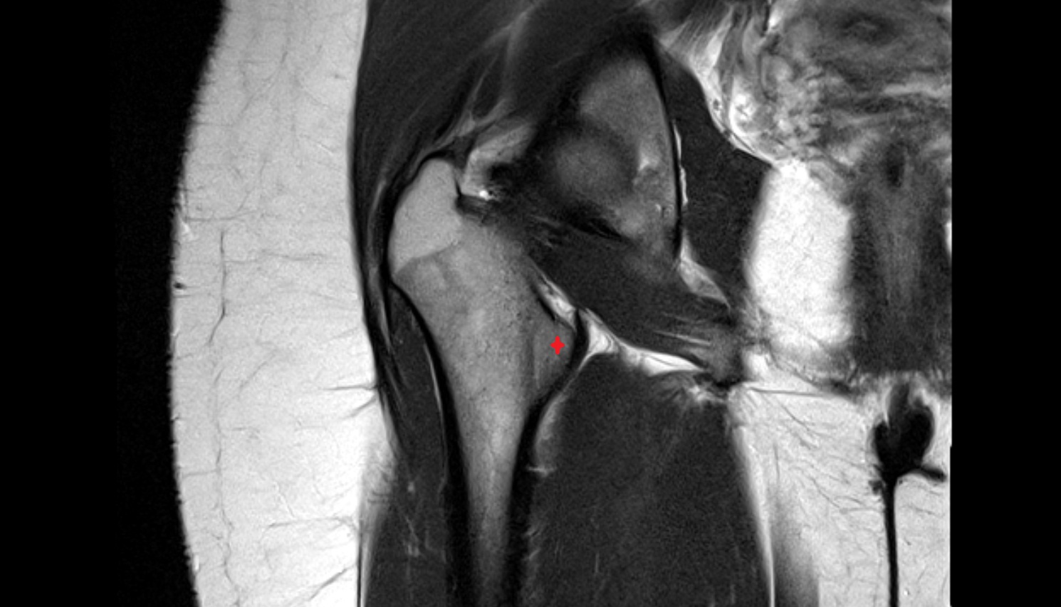 Lesser trochanter  MRI CORONAL   anatomy image-img-00000-00000