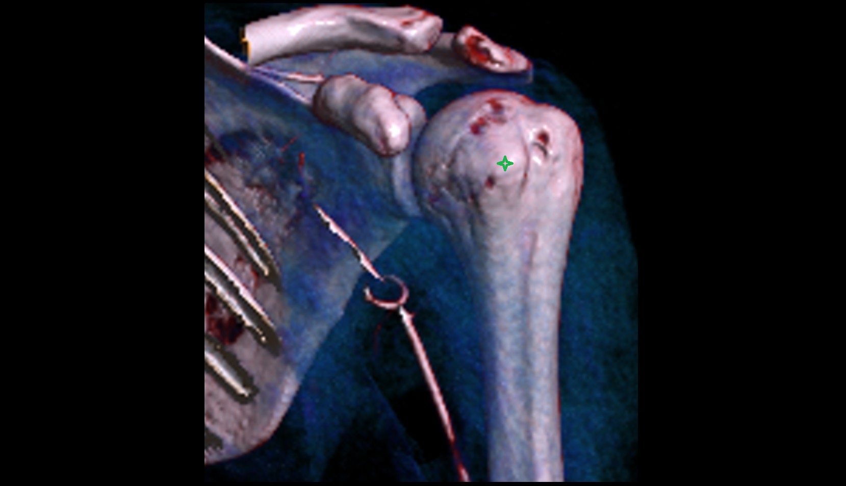 Lesser tubercle of humerus 3d vrt image