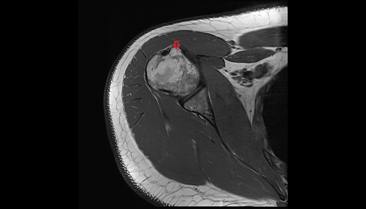 Lesser tubercle of humerus  axial cross sectional anatomy 3T MRI AI enhanced radiology image-img-00000-00000