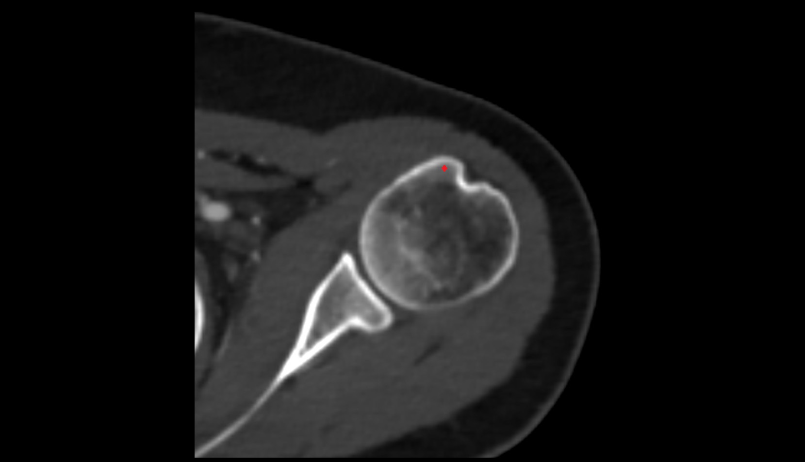 Lesser tubercle of humerus ct axial image