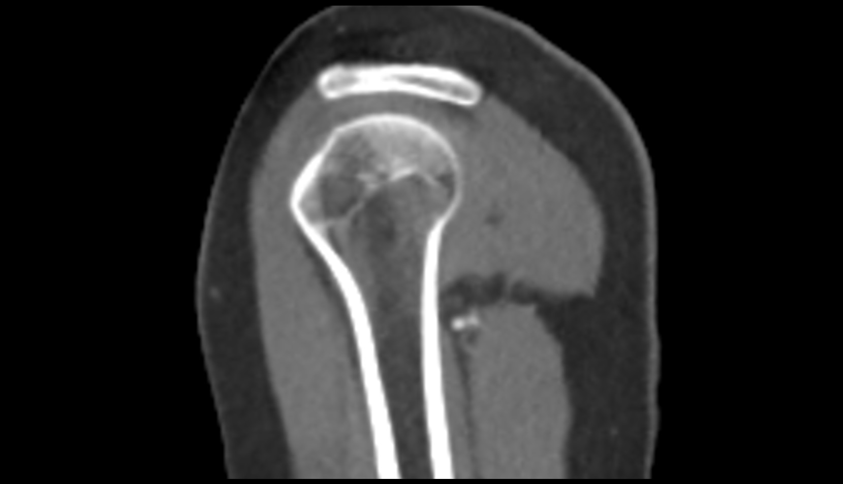 Lesser tubercle of humerus ct sag image