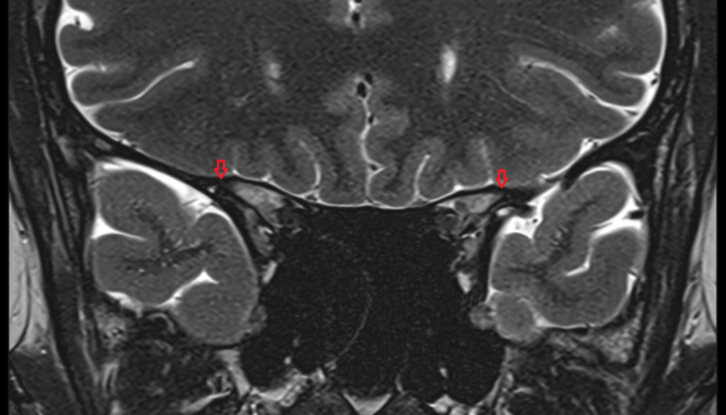 Lesser wing of sphenoid -img-00000-00000