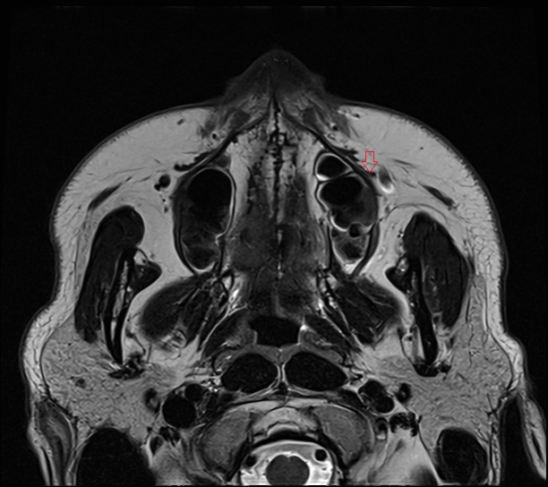 Levator anguli oris muscle MRI AXIAL IMAGE
