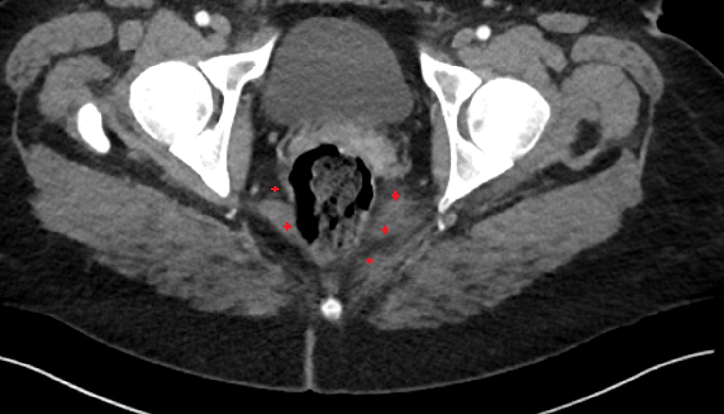 Levator ani muscle   CT  axial  anatomy  image-img-00000-00000