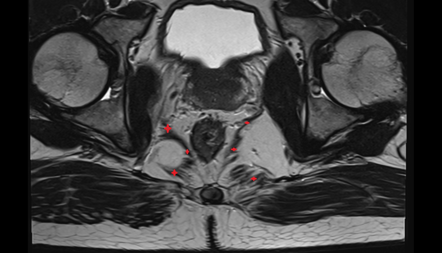 Levator ani muscle   MRI  axial  anatomy  image-img-00000-00000