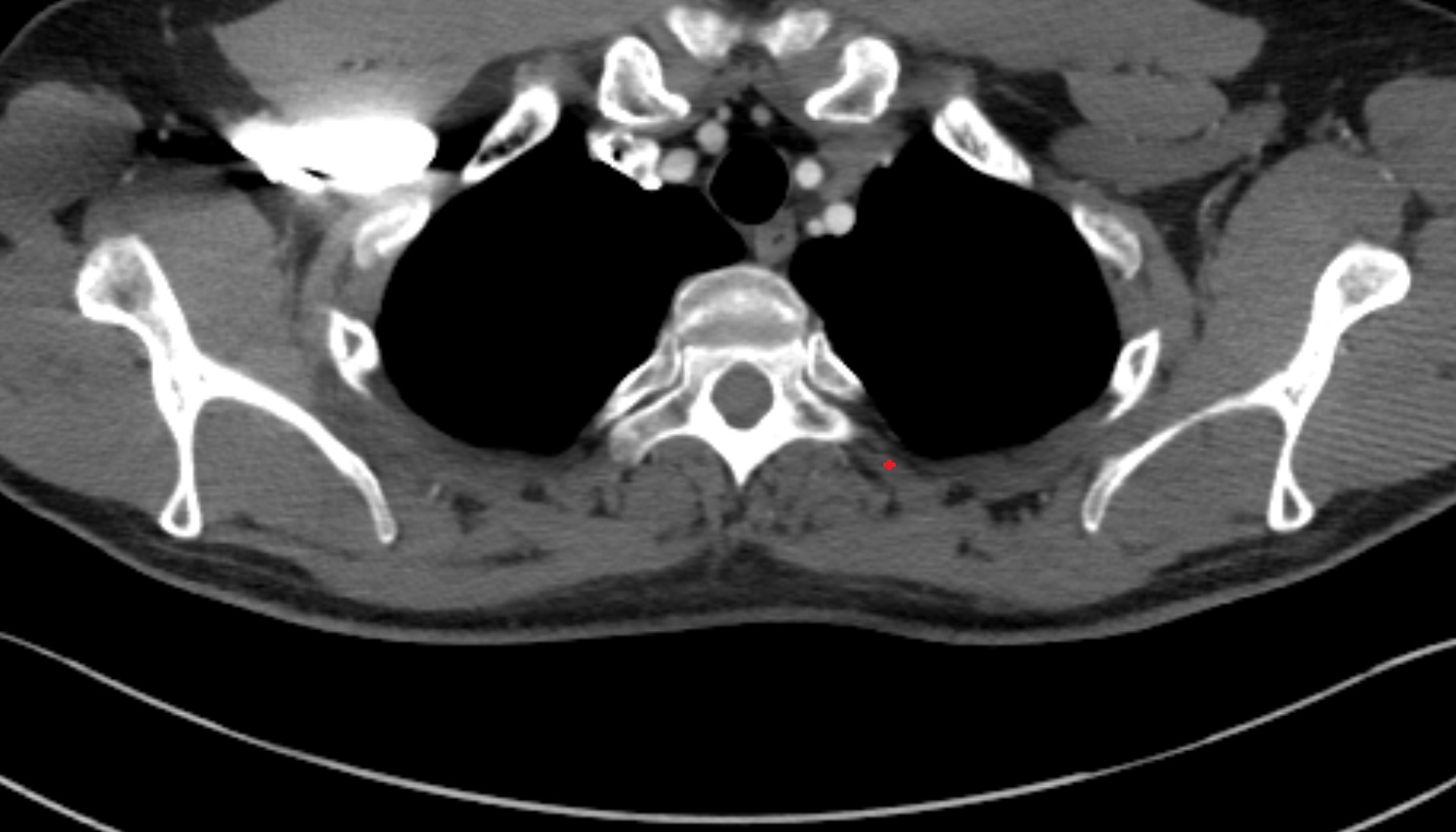 Levatores costarum muscle muscle muscle anatomy CT axial  image -img-00000-00000