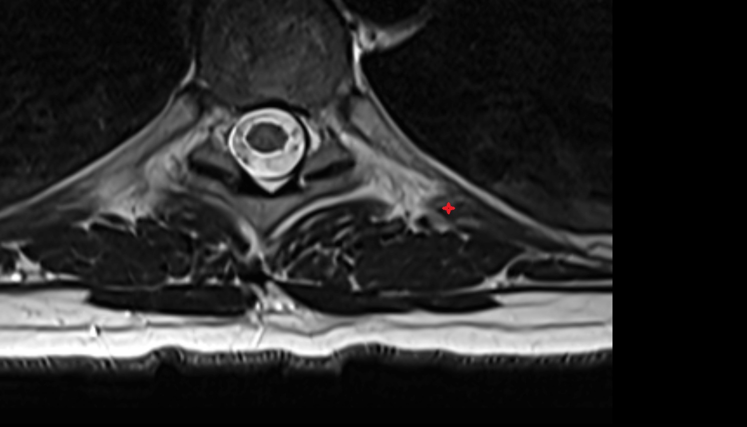 Levatores costarum muscle muscle muscle anatomy MRI axial  image -img-00000-00000