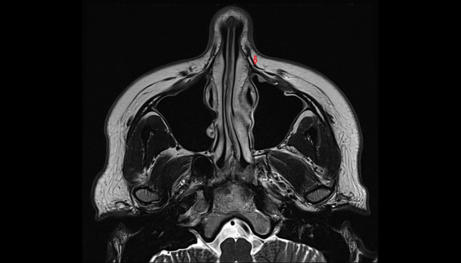 Levator labii superioris alaeque nasi muscle -img-00000-00000
