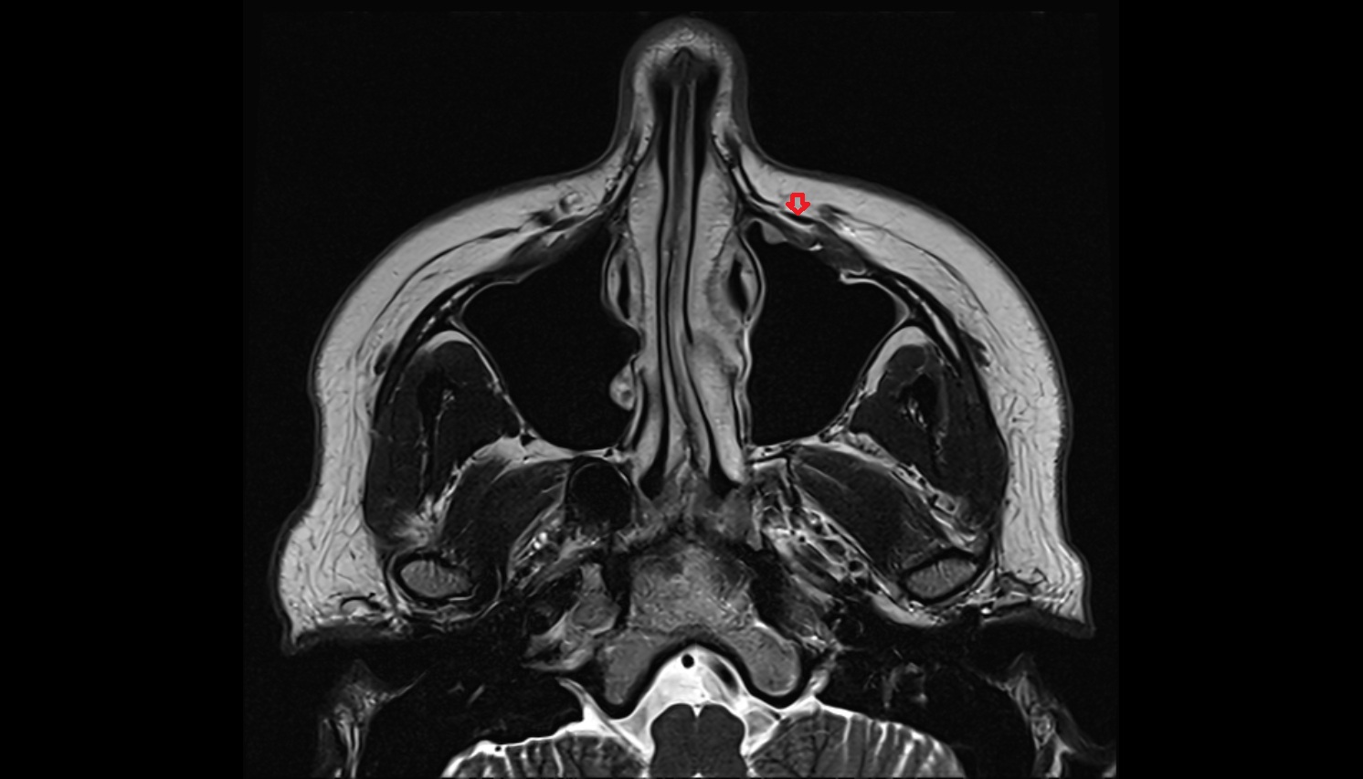 Levator labii superioris muscle-img-00000-00000