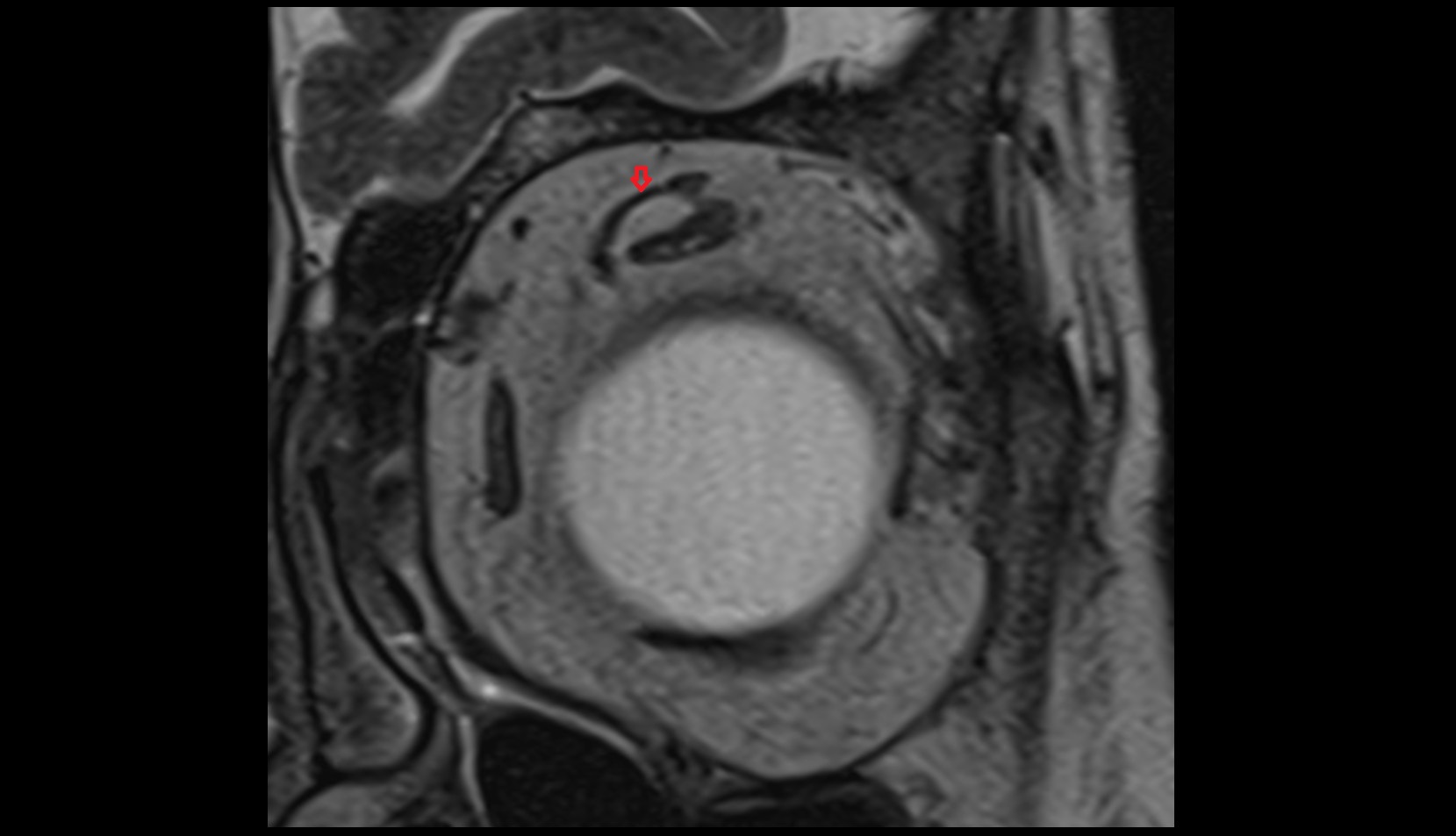 Levator palpebrae superioris muscle mri coronal image