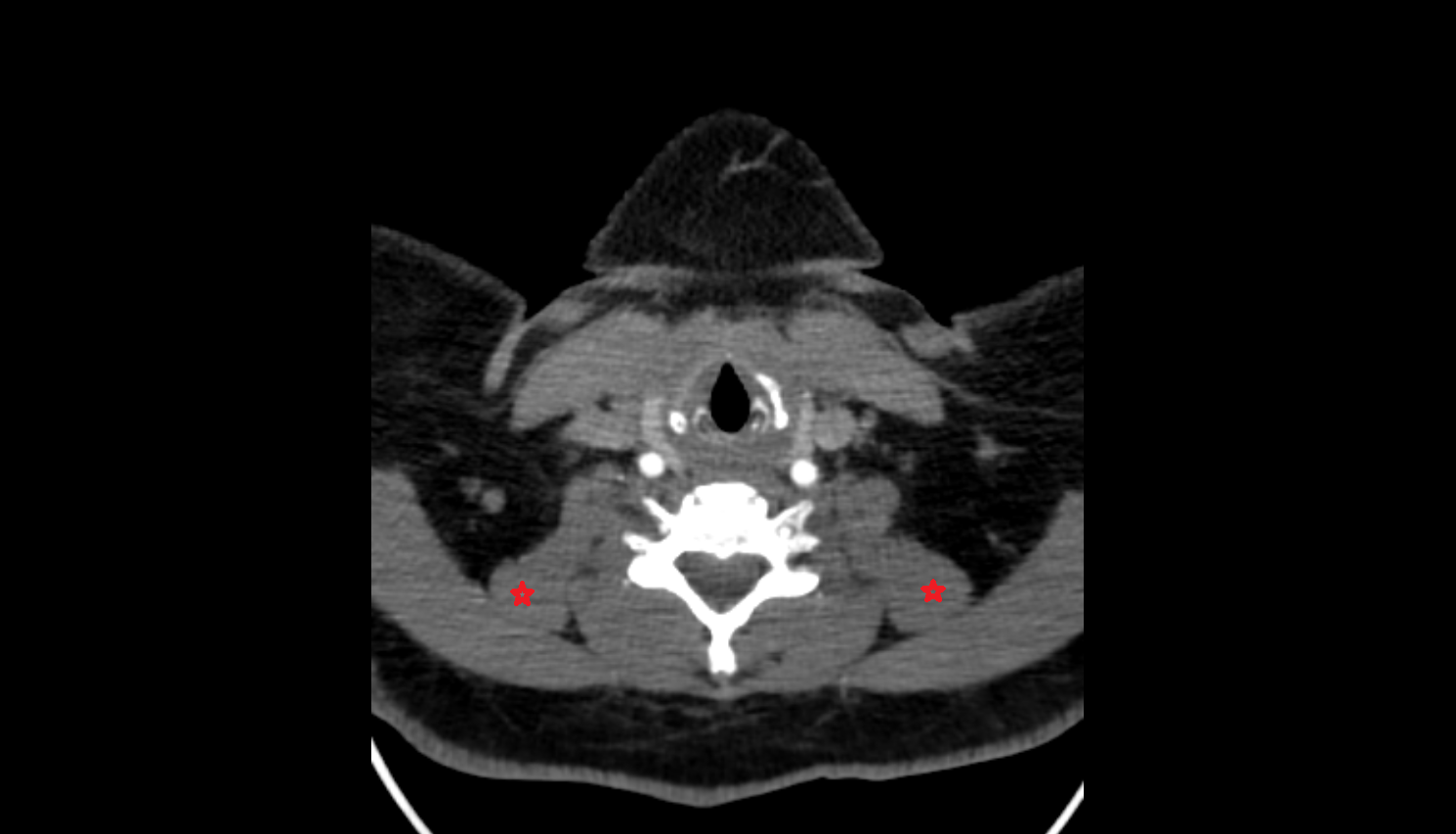 Levator scapulae muscle CT axial  image-img-00000-00000