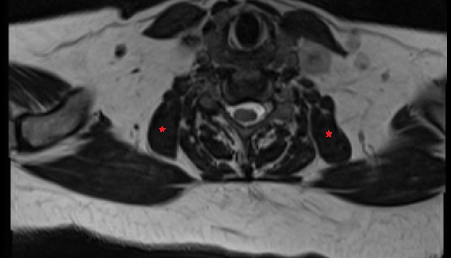 Levator scapulae muscle  mri axial image -img-00000-00000