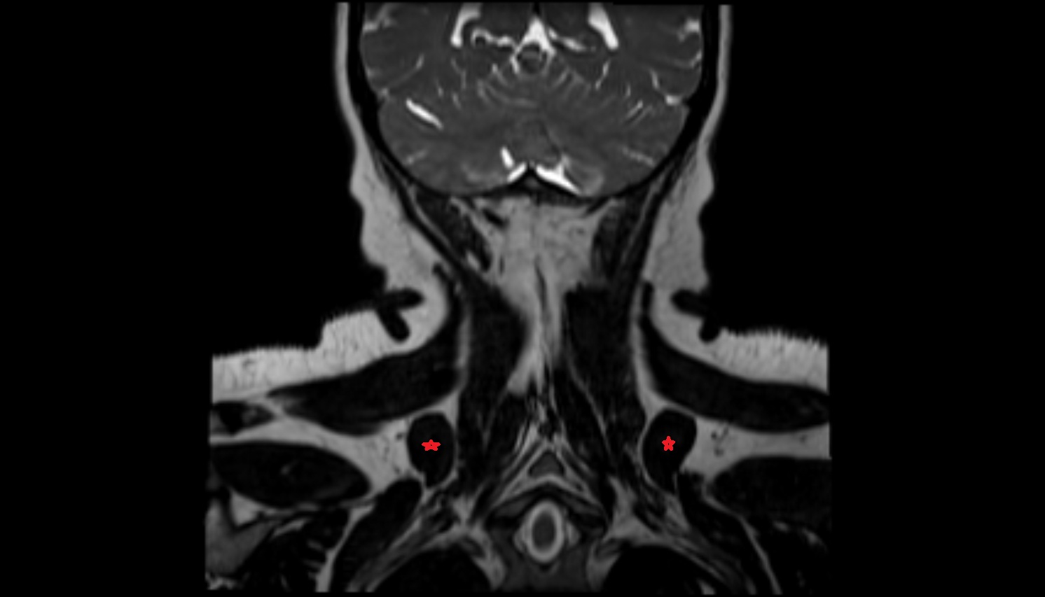 Levator scapulae muscle  mri coronal image -img-00000-00000