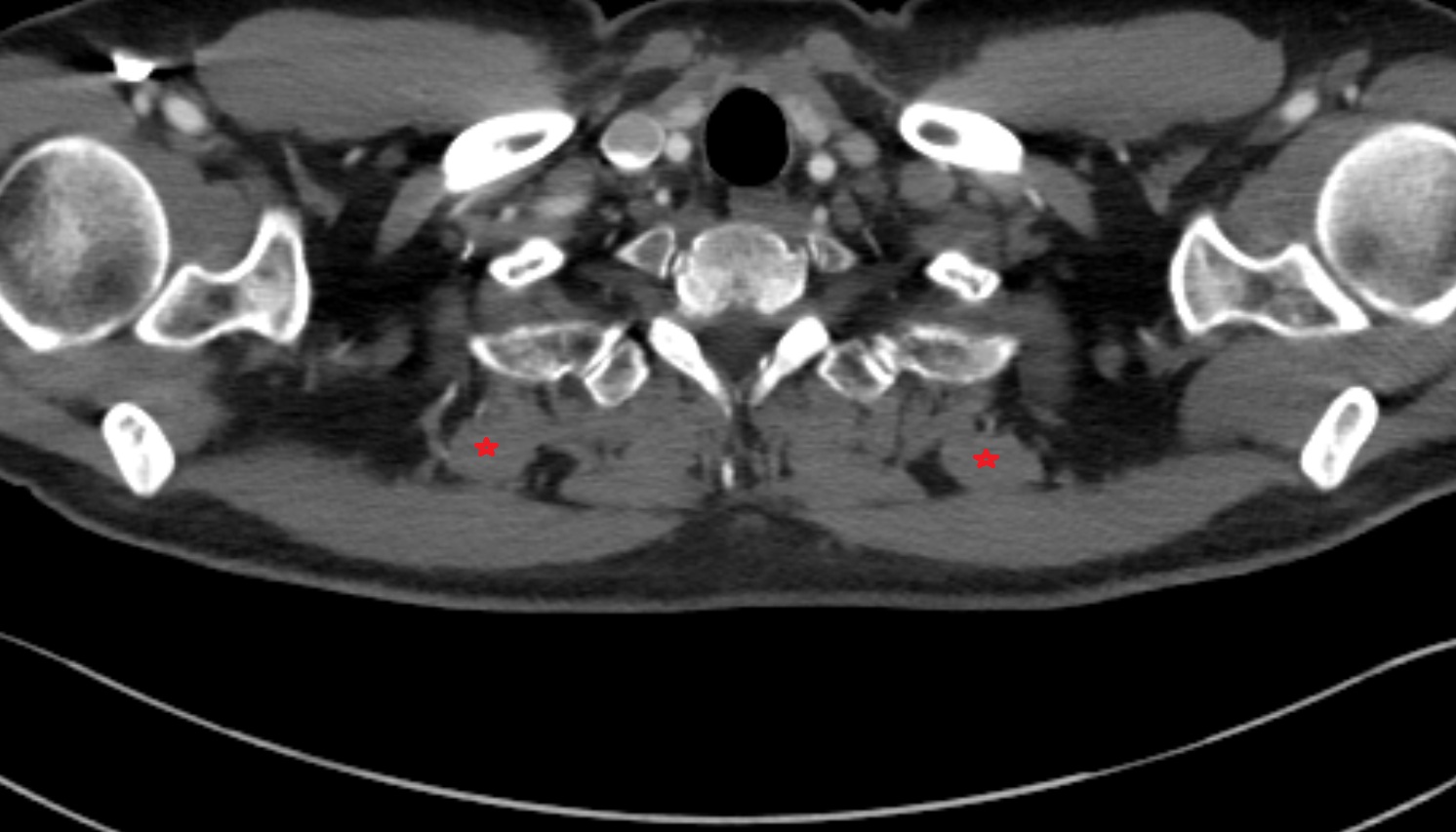 Levator scapulae muscle muscle anatomy CT axial  image -img-00000-00000