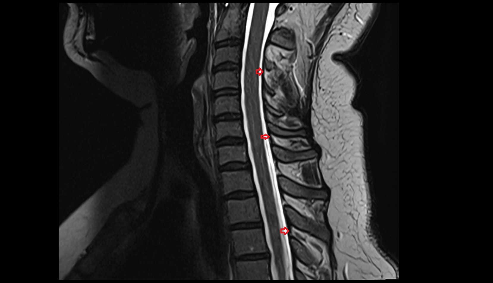 Ligamenta flava c spine