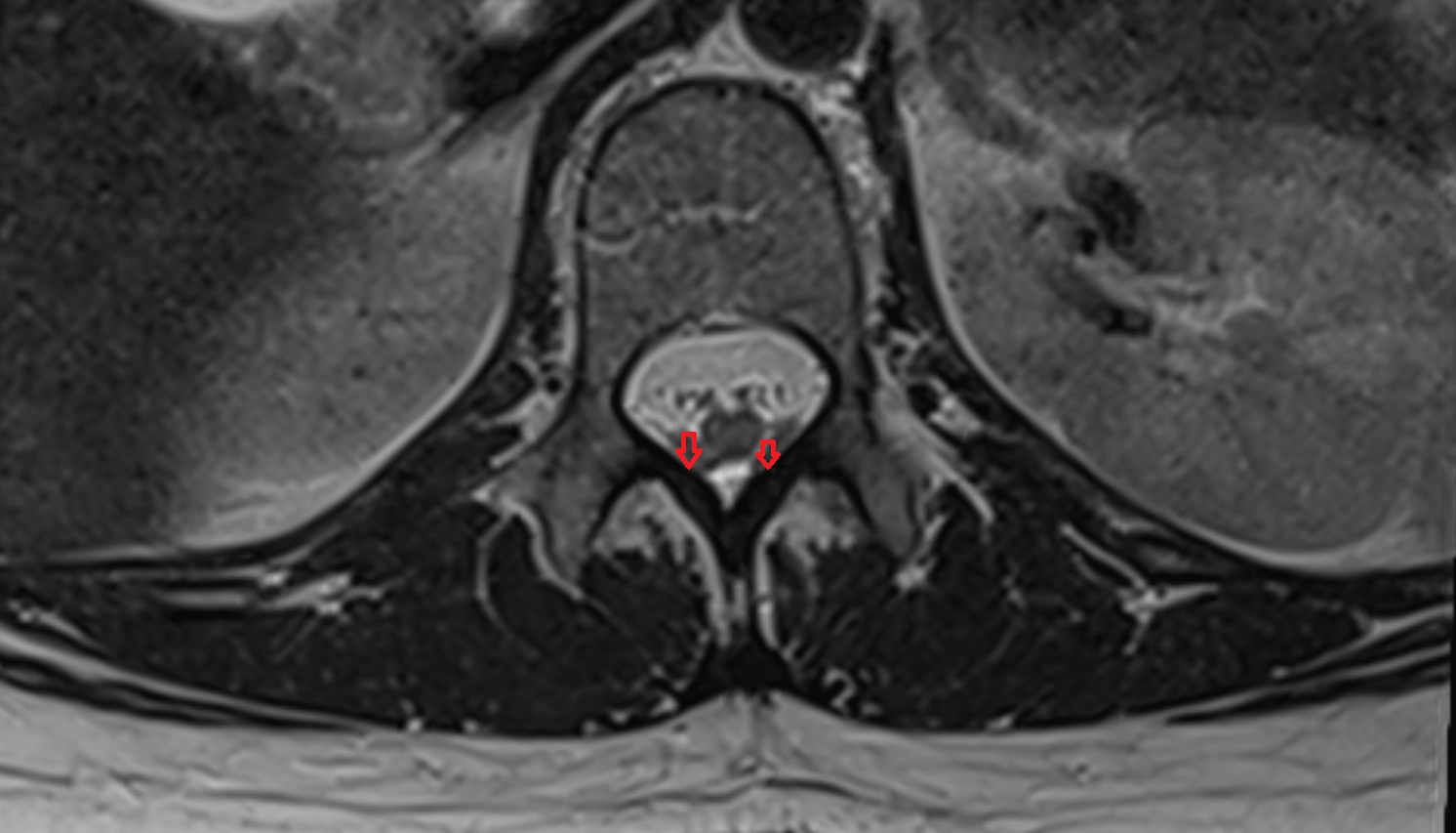 Ligamenta flava  mri axial  image -img-00000-00000