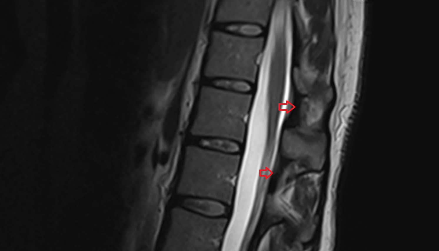 Ligamenta flava  mri sag image -img-00000-00000