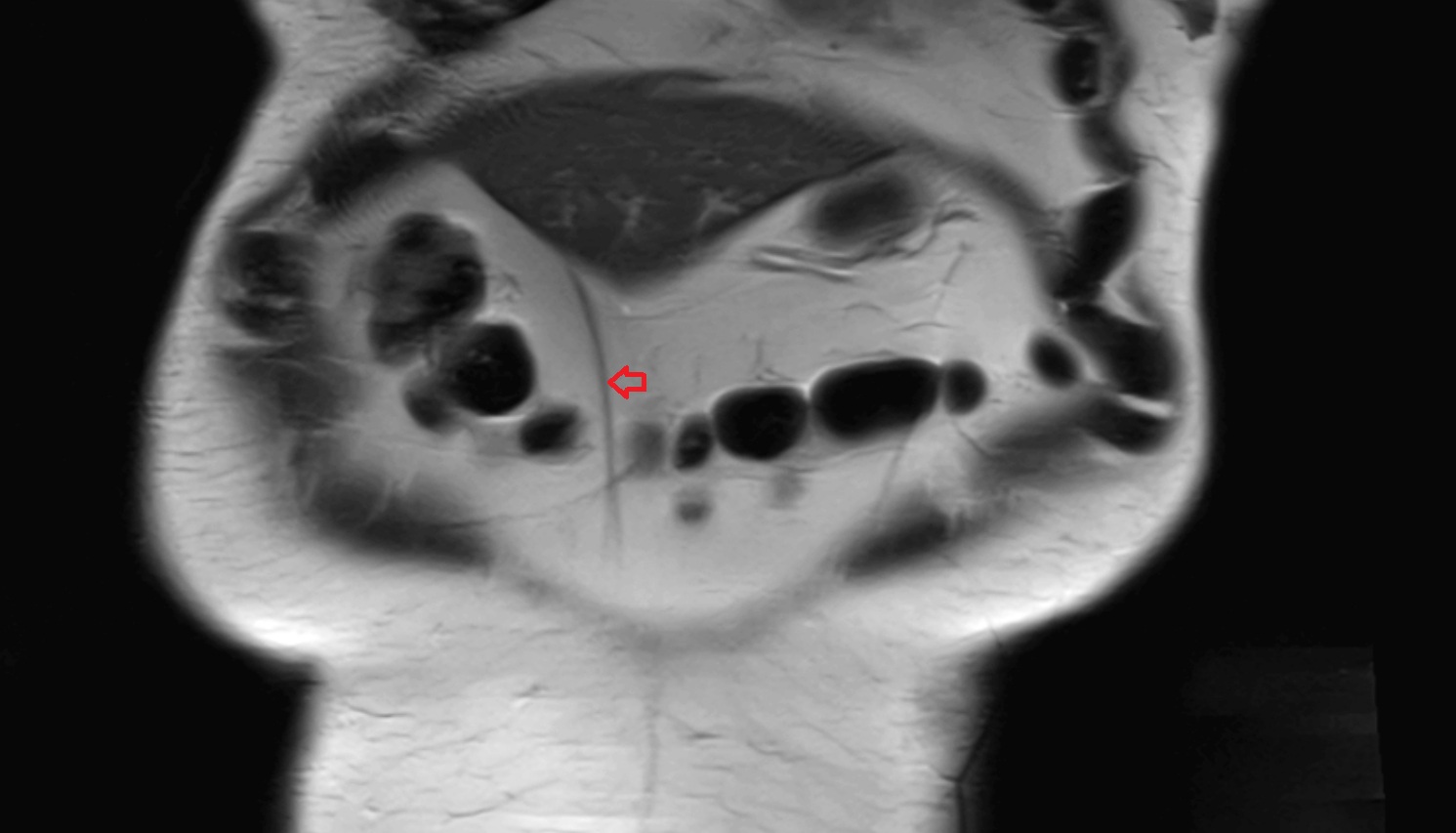 Ligamentum Teres (Round Ligament of the Liver)   MRI coronal  anatomy  image -img-00000-00000