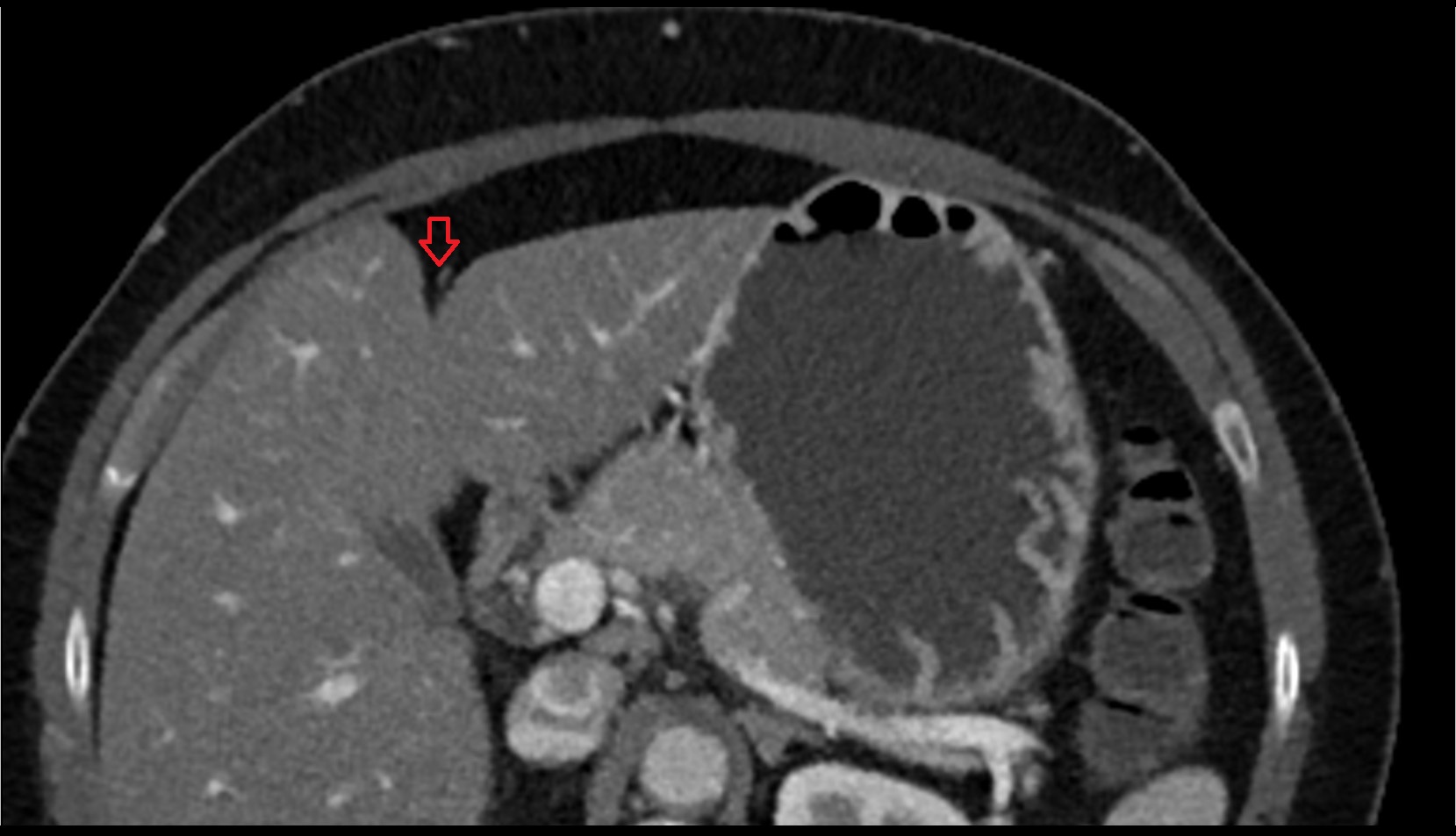 Ligamentum Teres (Round Ligament of the Liver) ct axial