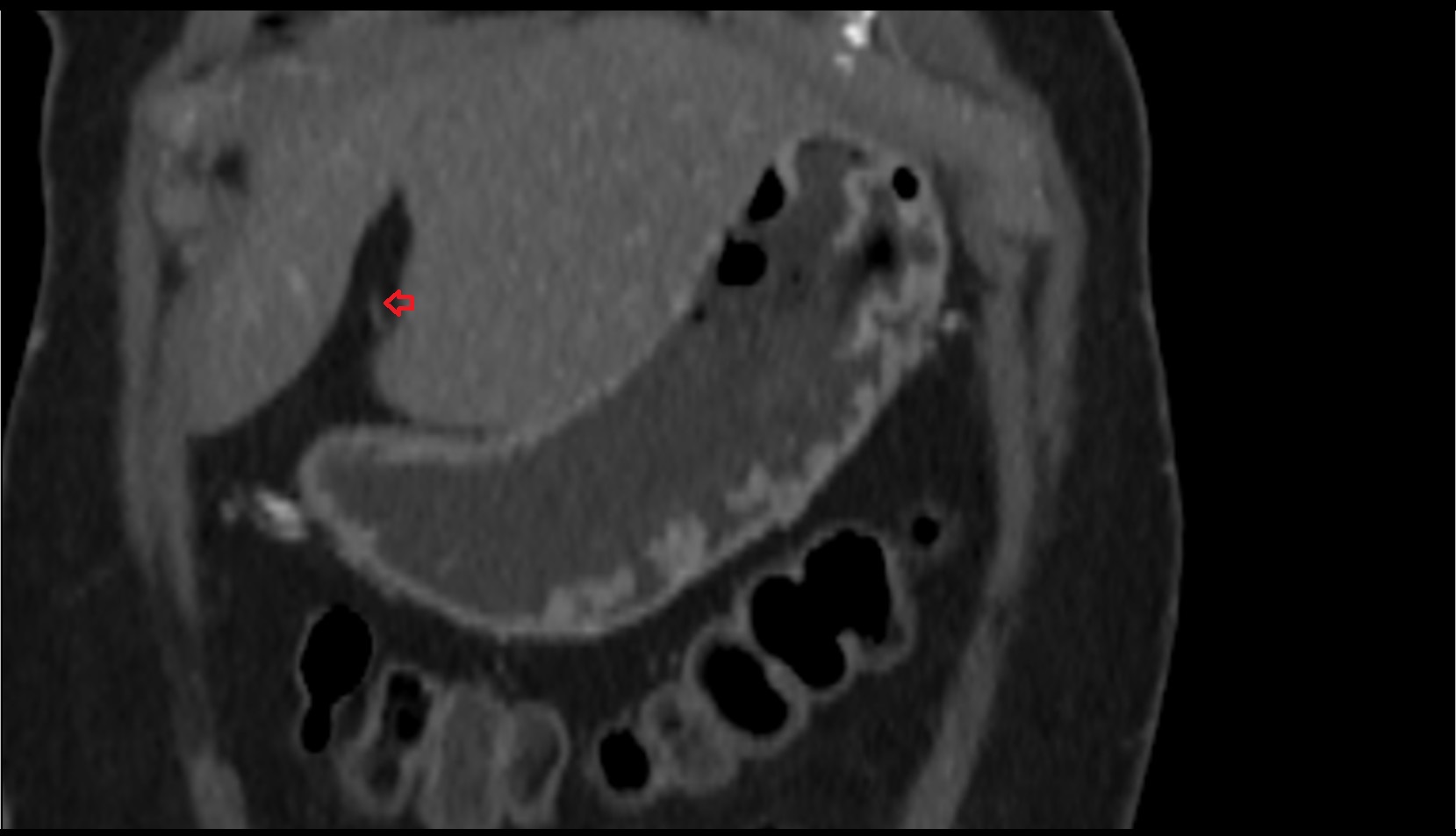 Ligamentum Teres (Round Ligament of the Liver) ct coronal image