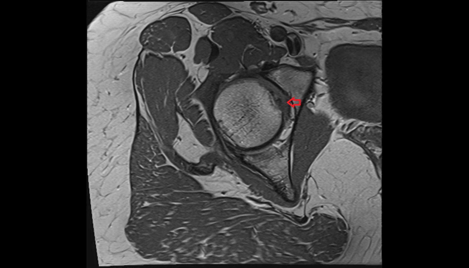 Ligamentum Teres (ligament of the head of femur)  MRI axial anatomy image-img-00000-00000