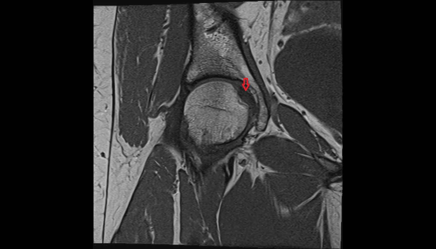 Ligamentum Teres (ligament of the head of femur)  MRI  coronal  anatomy image-img-00000-00000